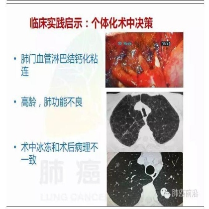 肺癌新分期和分类--临床和研究启示