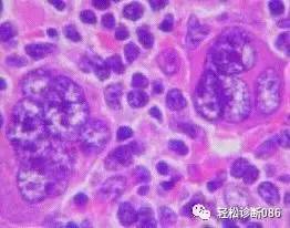 霍奇金淋巴瘤(2)