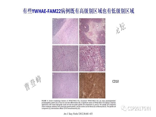 妇科肿瘤病理新进展——子宫间叶肿瘤进展