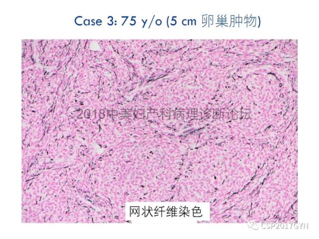女性生殖道发育