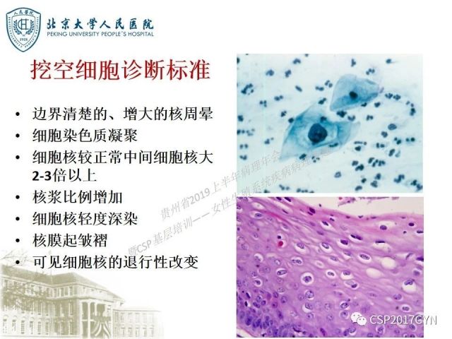 中华病理学会基层培训遵义站讲座（三）——宫颈鳞状上皮病变的病理诊断与鉴别诊断