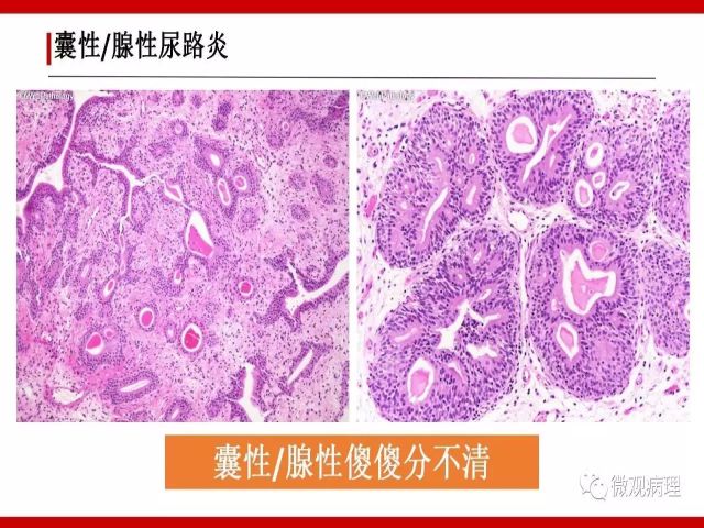 泌尿课程/尿路腺样病变的诊断要点