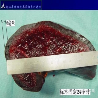《常规免疫组化初筛ALK阳性非小细胞肺癌专家共识》技术部分解读