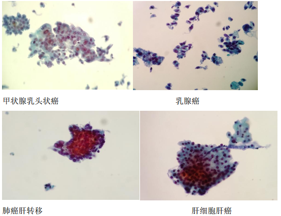 中国医学科学院肿瘤医院进修体会