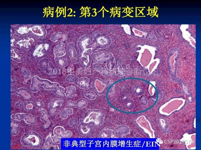 子宫内膜癌：诊断与进展