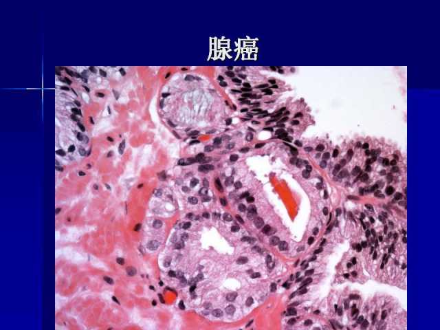 前列腺病理诊断线索（上）——黄教悌
