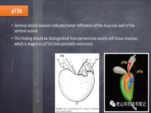 AJCC第8版 前列腺癌分期 之 病理学要点