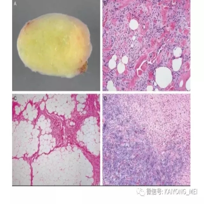 女性生殖道软组织肿瘤病理诊断及进展（二）