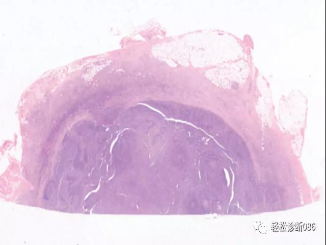 淋巴结反应性增生性病变（3）——滤泡模式