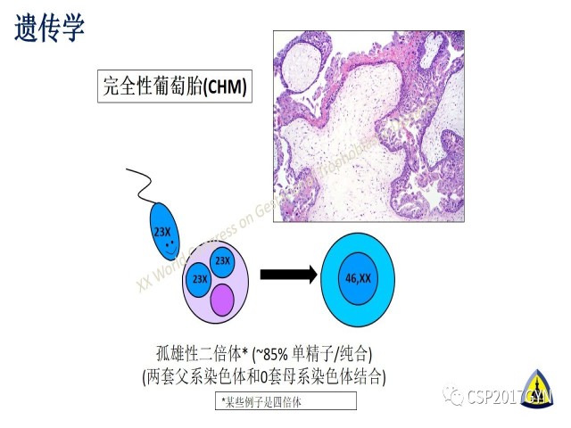 p57免疫组化染色及基因分型 在葡萄胎精确诊断中的应用