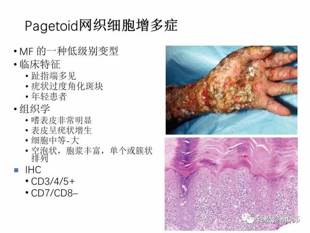 皮肤T细胞淋巴瘤