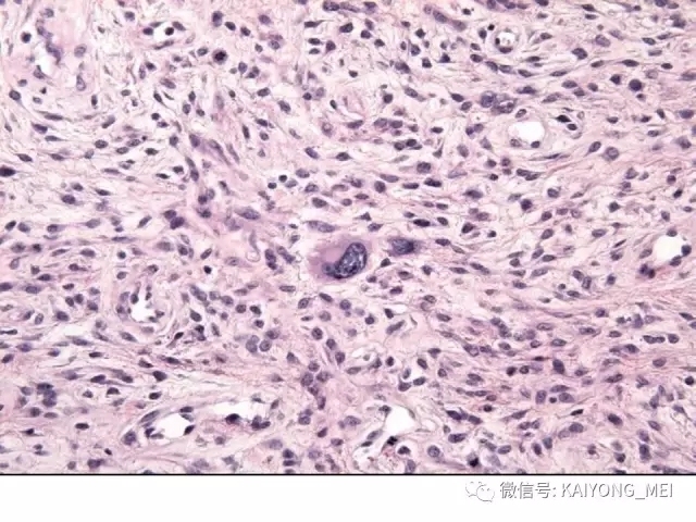 女性生殖道软组织肿瘤病理诊断及进展（一）