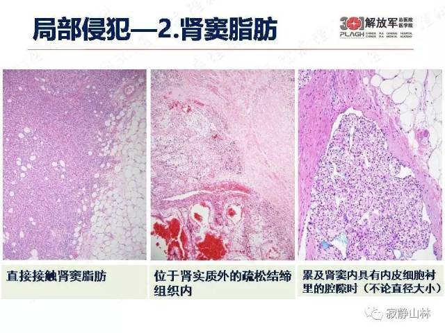 泌尿系统常见肿瘤标本病理报告规范