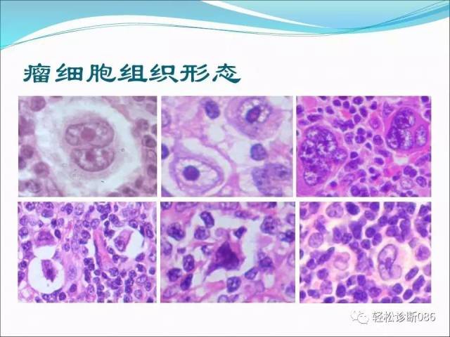 霍奇金淋巴瘤
