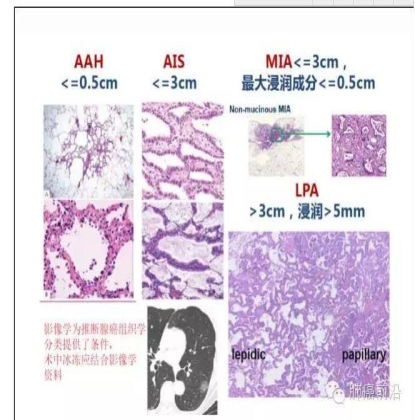 肺癌新分期和分类--临床和研究启示