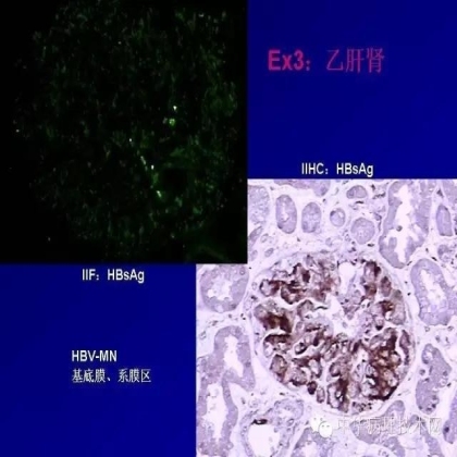 探讨免疫组织学在肾穿标本中的应用