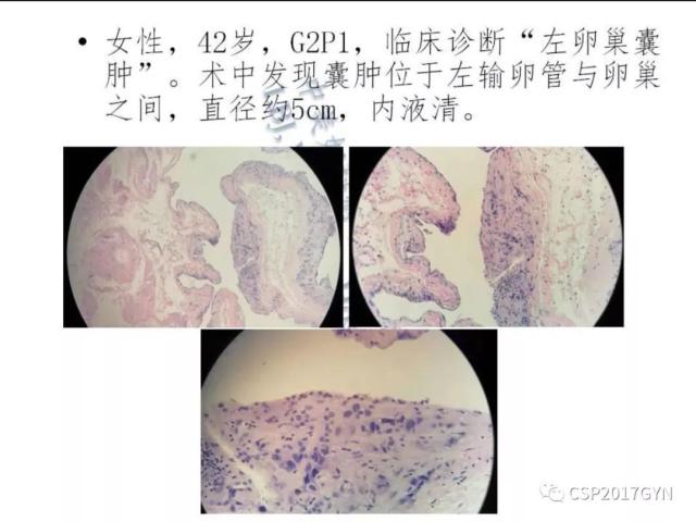 妊娠滋养细胞肿瘤的临床病理学进展