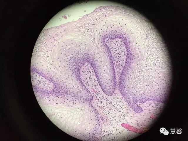 阴道鳞状上皮乳头状瘤？尖锐湿疣？（孔祥田老师病例分享，粉蓝医疗科技（杭州）有限公司女性生殖2群讨论，孔祥田(Max)*Roswell*老师讲解）