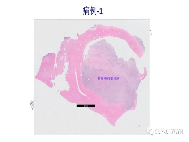 妇科肿瘤病理新进展——子宫间叶肿瘤进展