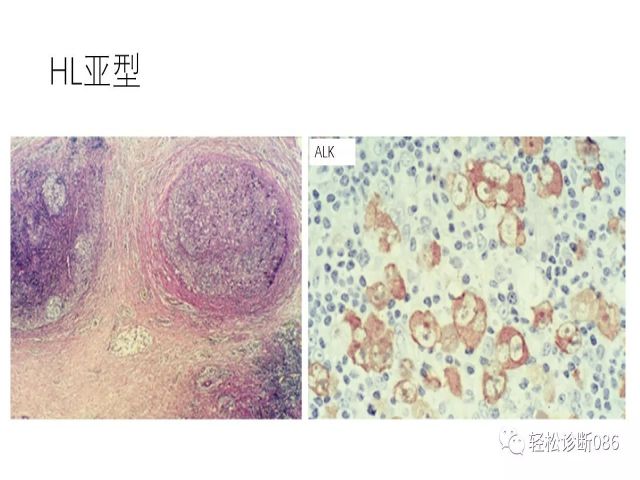 间变大细胞淋巴瘤