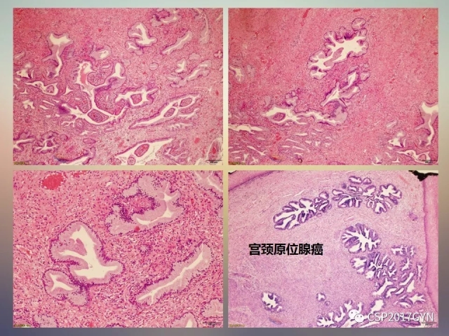 宫颈腺癌的临床病理研究进展