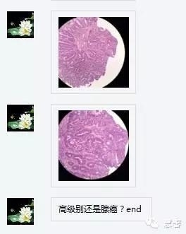 结、直肠管绒毛状腺瘤-高级别病变诊断等相关问题2（悄悄分享、孔祥田(Max)*Roswell*老师讲解）