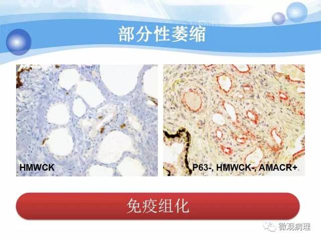 泌尿课程/局灶性前列腺萎缩