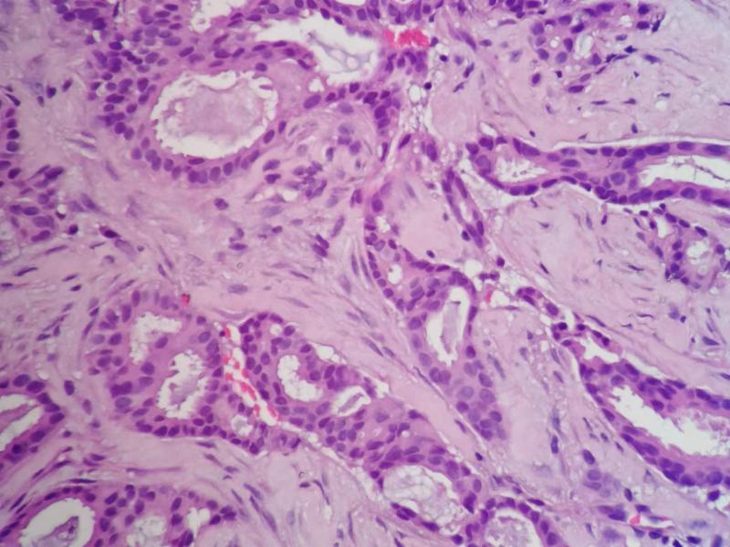 组织学1级的乳腺浸润性导管癌（札记七十五）