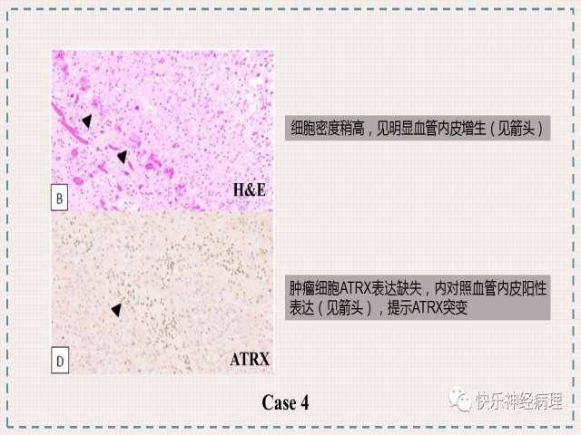 胶质瘤分子结果矛盾时如何整合诊断