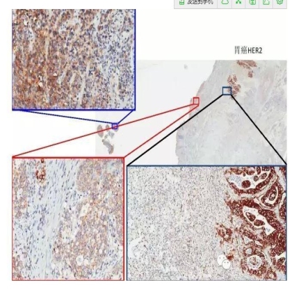 肿瘤精确医疗与分子病理检测