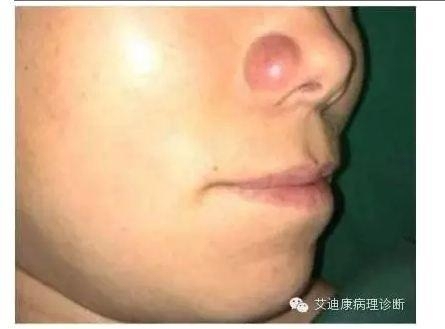 2016年版WHO淋巴瘤分类更新要点——黄雨华