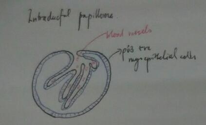 Breast papillary lesions
