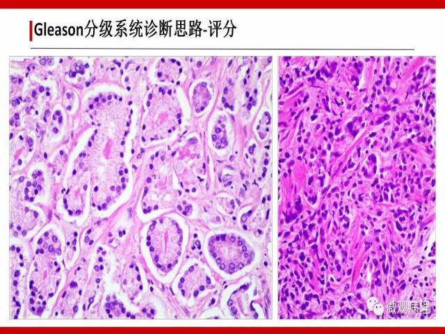 前列腺癌Gleason分级系统的前世今生