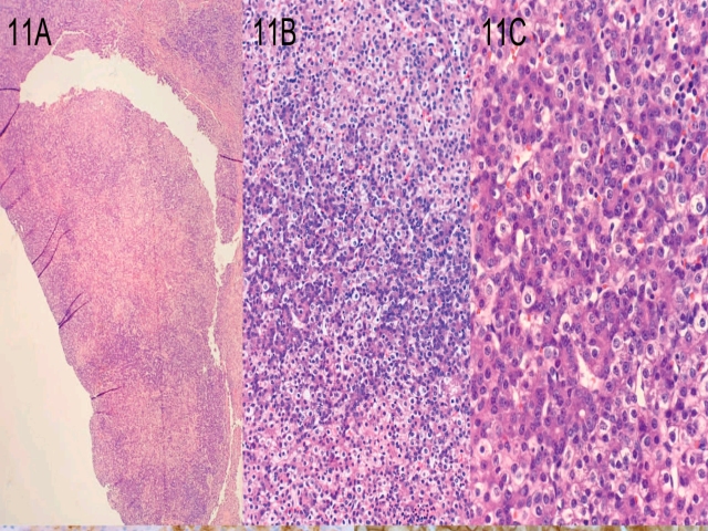 家族性腺瘤性息肉病综合征之庖丁解牛（五）