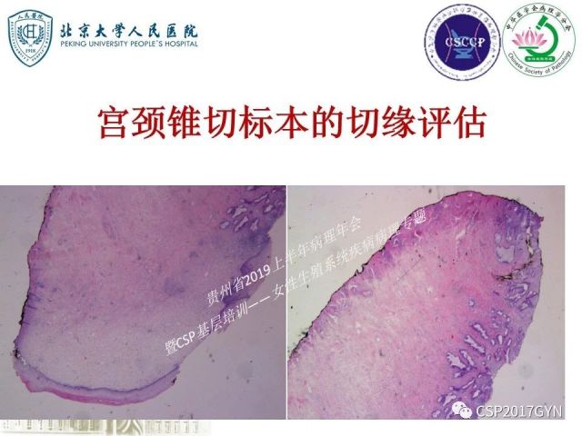 中华病理学会基层培训遵义站讲座（三）——宫颈鳞状上皮病变的病理诊断与鉴别诊断
