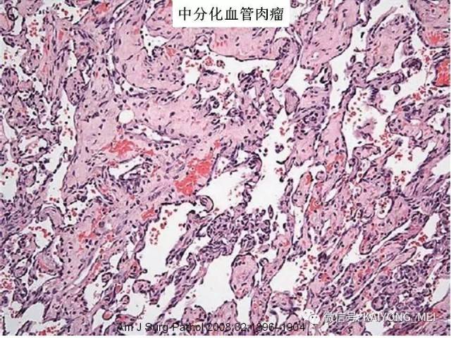 乳腺梭形细胞病变的病理诊断及进展（二）