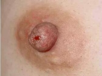 4张图认识乳腺癌早期症状