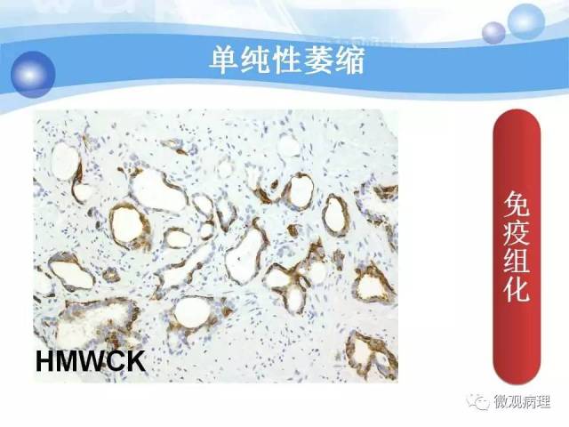 泌尿课程/局灶性前列腺萎缩