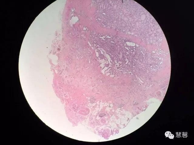 甲状腺乳头状癌伴喉返神经旁淋巴结中见小块分化好的甲状腺组织，转移癌？（阿姚分享，孔祥田(Max)*Roswell*NM老师讲解）