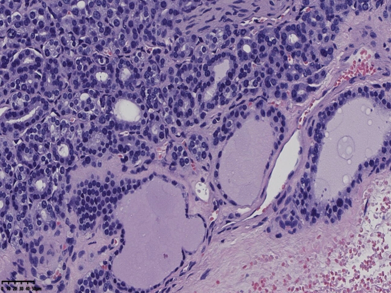 这个甲状腺肿瘤怎么看？