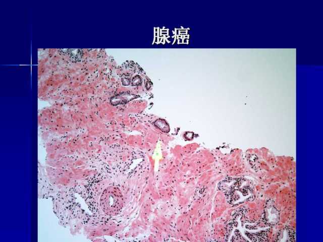 前列腺病理诊断线索（上）——黄教悌