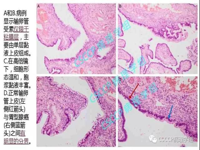 宫颈胃型腺癌中输卵管黏膜受累