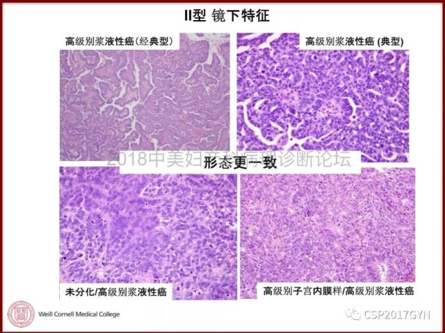 非粘液性卵巢肿瘤的诊断挑战