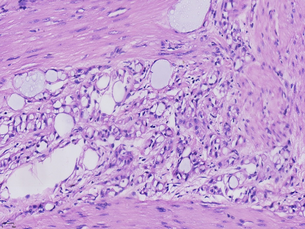 子宫腺瘤样瘤