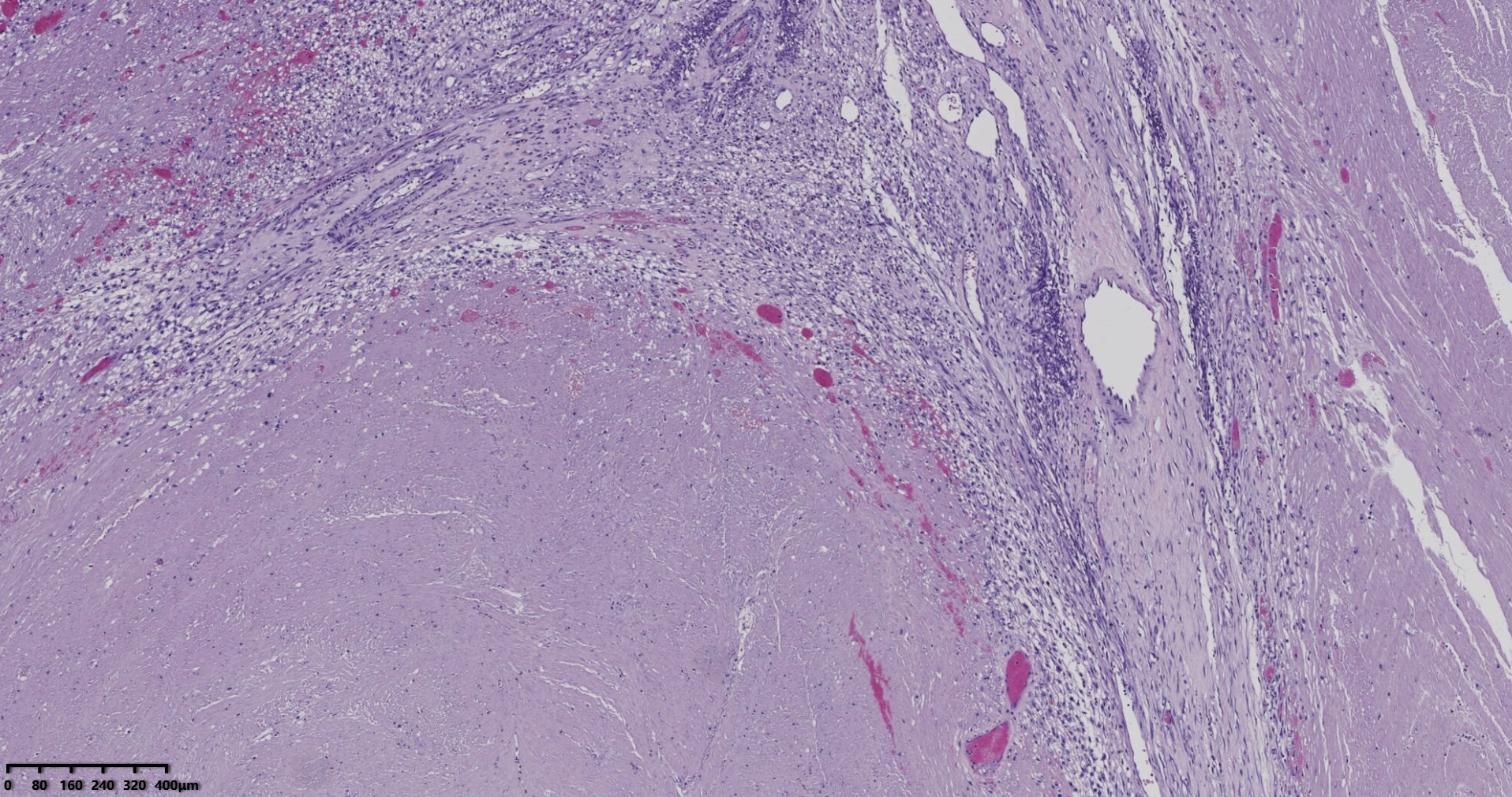 子宫多发性平滑肌瘤伴肉瘤