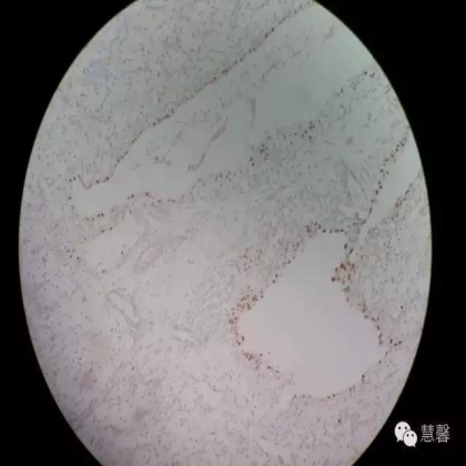 透明细胞乳头状肾细胞癌？TFE3 Traslocation Carcinoma？（赵洋分享，孔祥田(Max)*NM老师讲解）