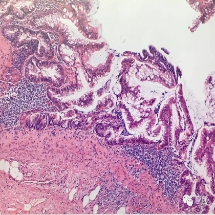 低级别黏液性肿瘤转移到卵巢伴腹腔假黏液瘤形成【小车】分享；【刘从容】老师讲解