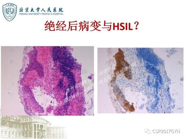 中华病理学会基层培训遵义站讲座（三）——宫颈鳞状上皮病变的病理诊断与鉴别诊断