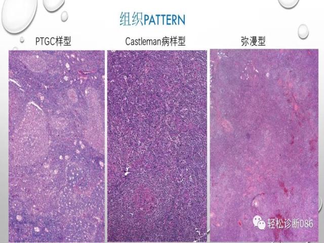 血管免疫母T细胞淋巴瘤的病理诊断