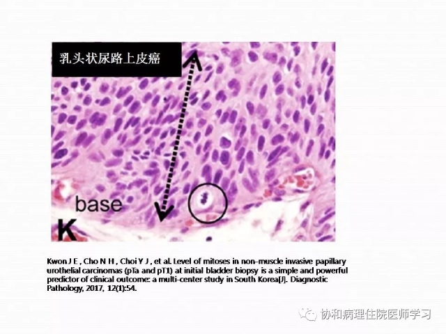 病理学基础知识 : 核分裂像的识别